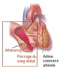 Athérome coronaire